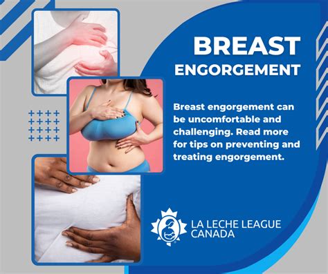 Breast Engorgement | La Leche League Canada - Breastfeeding Support and ...