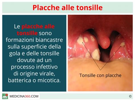 Placche Alle Tonsille Sintomi Cause Cure E Rimedi Naturali