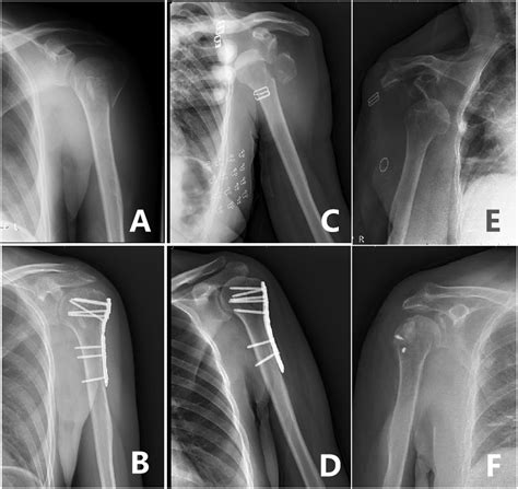 Surgical Position Of Lateral Tilted Supine Is Suitable For Proximal