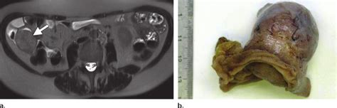 Leiomyoma In A 60 Year Old Woman Referred For Evaluation Of Unexplained Download Scientific