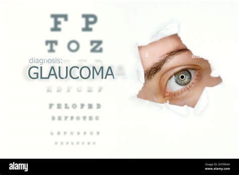 Póster Sobre La Enfermedad Del Glaucoma Con Prueba Ocular Y Ojo Azul A