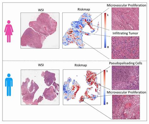 Ai Reveals Sex Specific Risk Factors In Glioblastoma Paving The Way