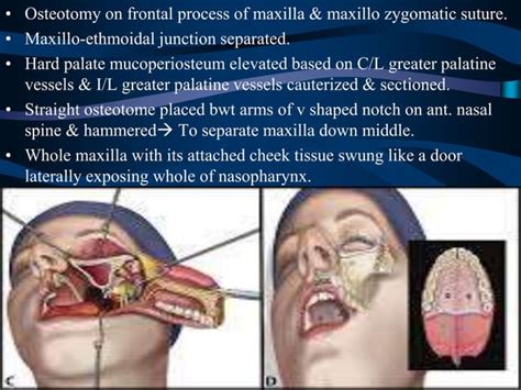 Surgical Anatomy Of Infratemporal Fossa By Dr Aditya Tiwari Ppt