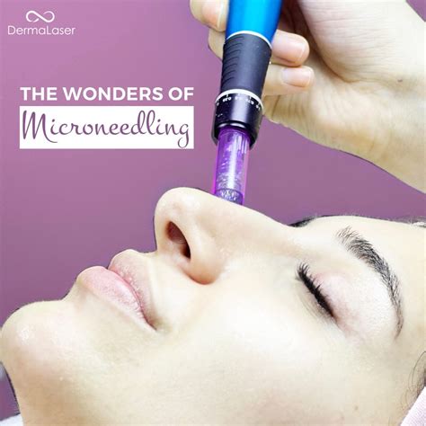 Facial Dark Pigmentation Treatment at Derma Laser | Derma Laser