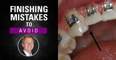 The POS Blog Everything You Need To Know About GP Orthodontics Case