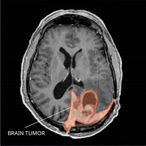 Meningioma National Cancer Institute