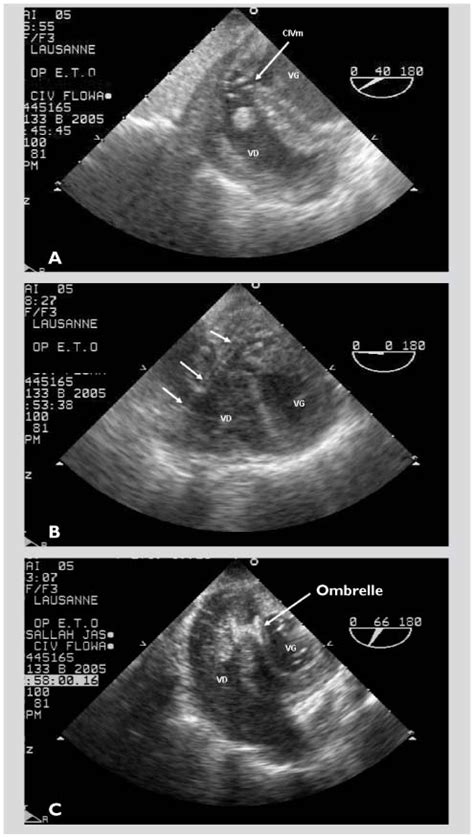 Interventions Hybrides Et Malformations Cardiaques Cong Nitales Revue