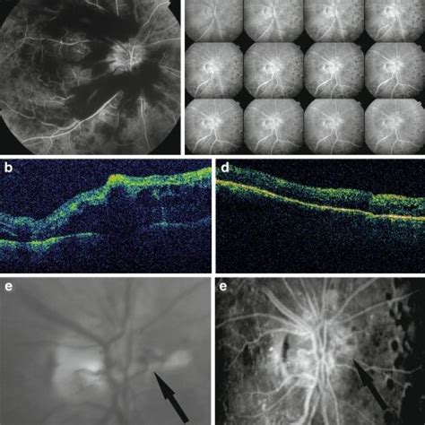 Patient A Preoperative Fluorescein Angiography Showing Macular Edema