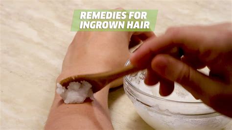 3 Simple Ways To Remove Deep Ingrown Hairs