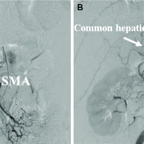 Superior mesenteric artery (SMA) and aorta angiography after the... | Download Scientific Diagram