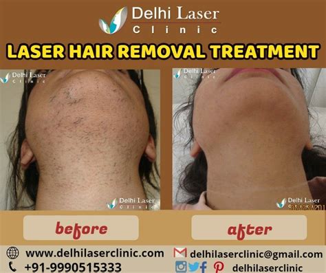 Laser Hair Removal Results After First Treatment