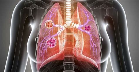 Obstructive Vs Restrictive Lung Disease Lung Institute