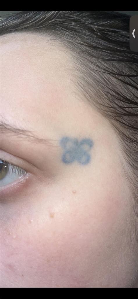 Face Tattoo Progress Pics (Blue Ink) : r/TattooRemovalSupport