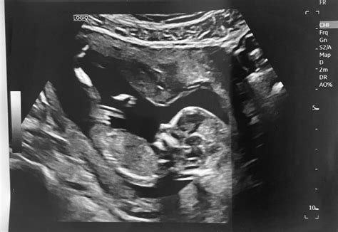 13 week ultrasound. Male or Female? | BabyCenter