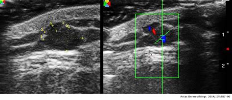 Subcutaneous Dermoid Cyst Ultrasound