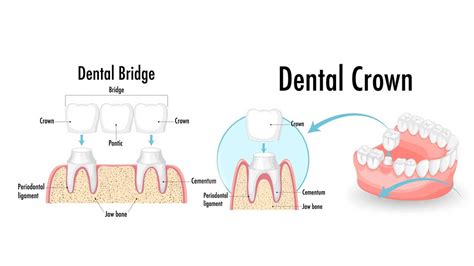 The Pros And Cons Of Dental Bridges Vs Crowns Dental Health