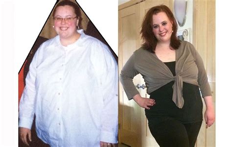 Gastric Bypass Before And After