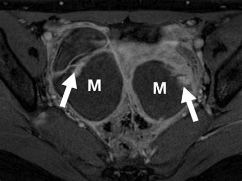 Mri Features Of Ovarian Cystic Lesions Park 2014 Journal Of