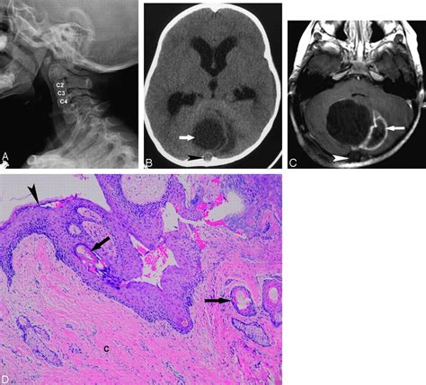 Posterior Fossa Dermoid Cysts In Association With Klippel Feil Syndrome