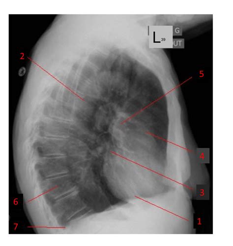 Lateral Chest Plain Radiograph Diagram Quizlet