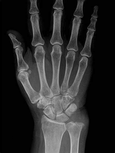 Anteroposterior A And Lateral B Radiographs Demonstrating No