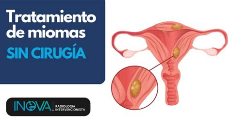 Alimentos Y Miomas Uterinos