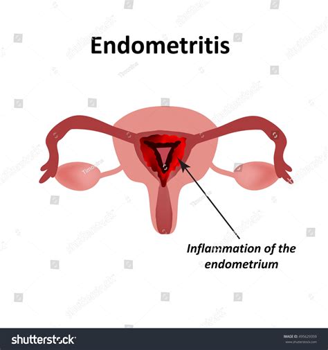 Endometritis Inflammation Of The Endometrium Inflammation Of The