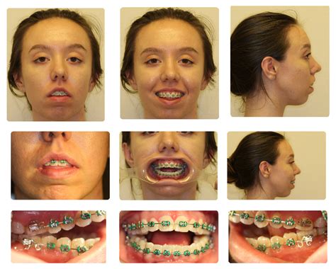 TMJ Replacement Surgery Naperville, Joliet, Yorkville IL