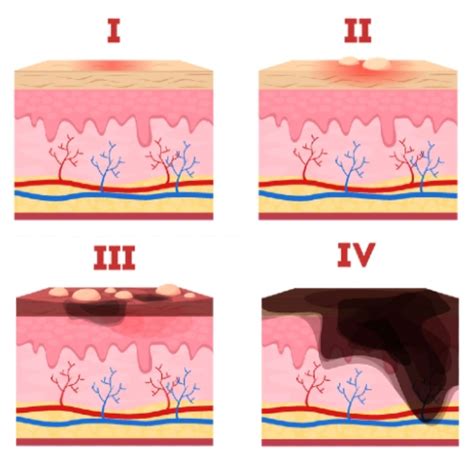 Minor Burns And Scalds Treatment