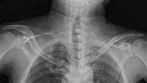 Clavicle Shaft Fractureorif