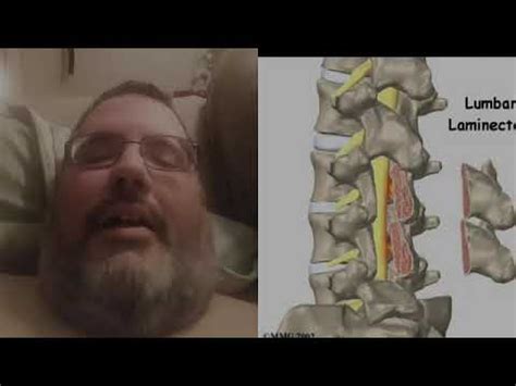 Laminectomy Recovery Day 5 YouTube