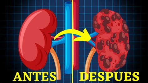 Alerta Insuficiencia Renal Como dañas tu riñones y señales de que