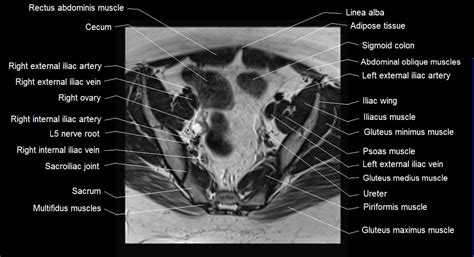 Female Pelvis Anatomy Free Axial Cross Sectional Anatomy Of Female Pelvis