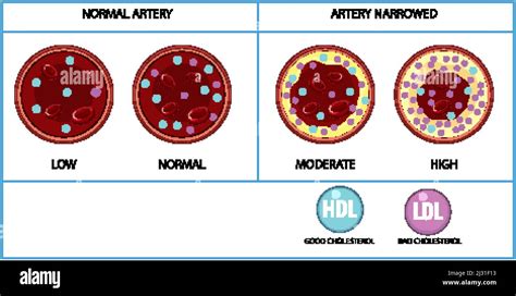 Types Of Cholesterol HDL And LDL Illustration Stock Vector Image Art