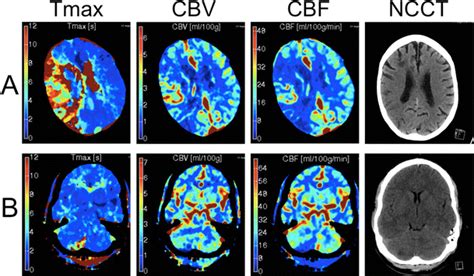 Computed Tomography Perfusion As A Diagnostic Tool For Seizures After