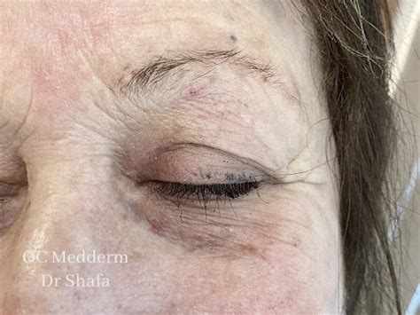 Xanthelasma Removal Irvine & Orange County | Dr. Parvin Shafa