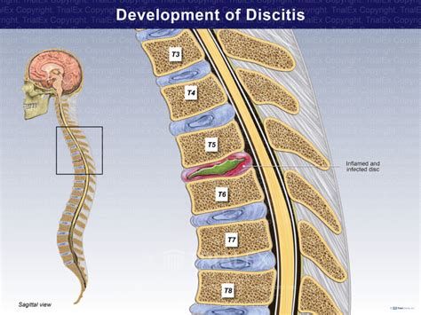 Development Of Discitis Trialexhibits Inc