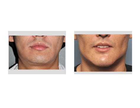 Case Study Male Custom Jawline Implant Reshaping Explore Plastic