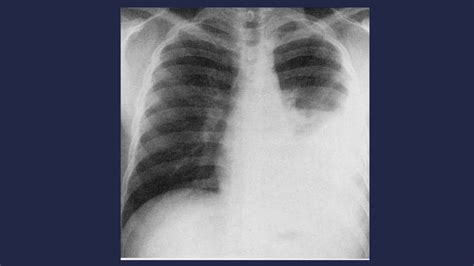 Tuberculosis Pulmonar En La Radiografía De Tórax Ppt