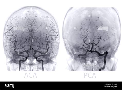 Cerebral Angiography Image From Fluoroscopy In Intervention Radiology Showing Cerebral Artery