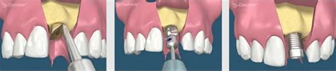 Dental Implants Montreal Tooth Implant Maxillo 3 Lacs