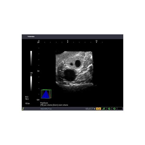 Combination Iup Ectopic Pregnancy Transvaginal Ultrasound Training