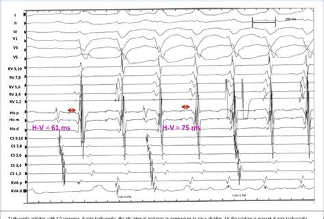 Figure From Clinical Features And Sites Of Ablation For Patients With