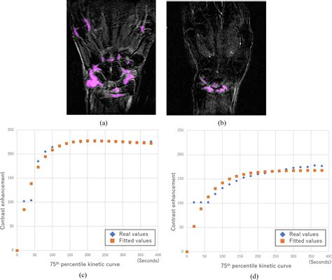 Mathematical Model For Histogram Analysis Of Dynamic Contrast Enhanced