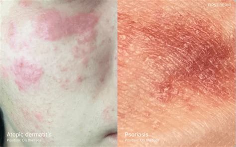 Eczema Atopic Dermatitis Vs Psoriasis Understanding The Differences