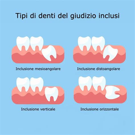 Dente Del Giudizio Incluso Sintomi Estrazione Complicanze