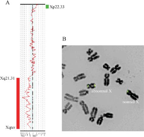 Microarray Cgh And Fish Analyses Of X Chromosomes In Case A Dna