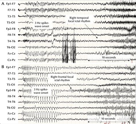 Jle Epileptic Disorders Generalized To Focal Epilepsy