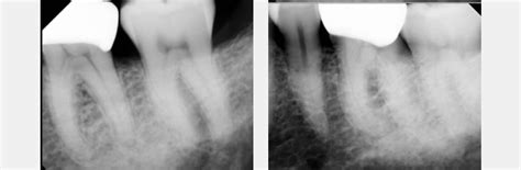 Identifying Pulpal Necrosis For Endodontic Treatment Spear Education