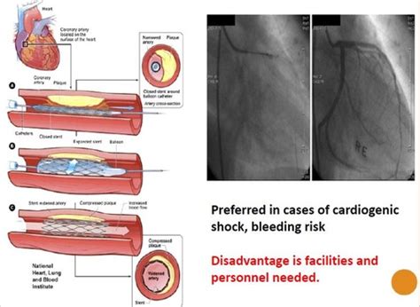 Nurs Acs Exam Flashcards Quizlet